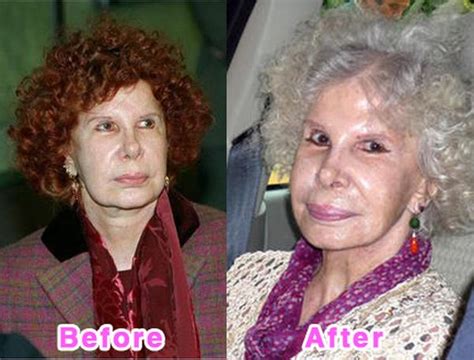 Celebrity Plastic Surgery Disasters Before And After 16 Pics