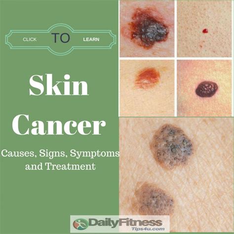 Skin Cancer Causes Signs Symptoms And Treatment