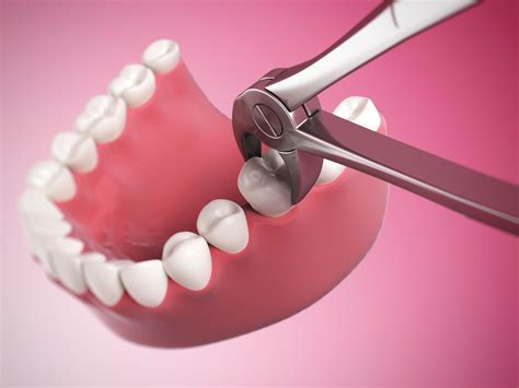 The 2 Types Of Tooth Extractions Tulsa Precision Dental
