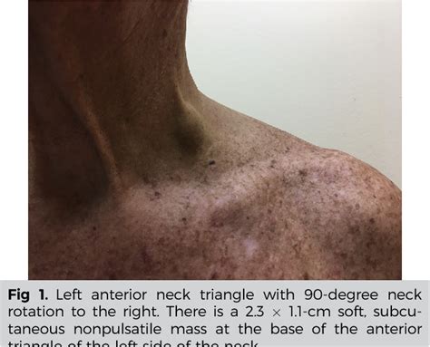 External Jugular Vein Thrombosis Secondary To Deep Tissue Neck Massage