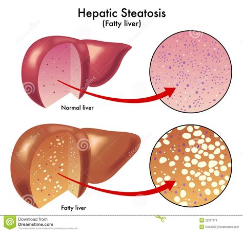Hepatic Steatosishtml Hepatic Steatosis Also
