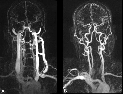 Fig 1 Suboptimal Contrast Opacification Of Dynamic Head And Neck Mr