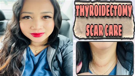 THYROIDECTOMY UPDATE SCAR CARE YouTube