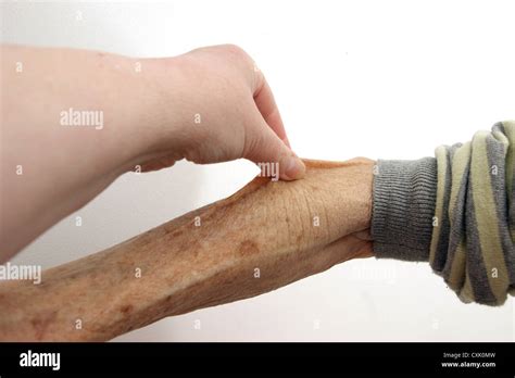 Elderly Woman Having Forearm Pinched To Illustrate A Skin Turgor