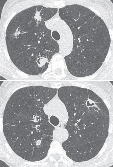 Rheumatoid Nodules In A 50 Yo Female Smoker Patient Who Have