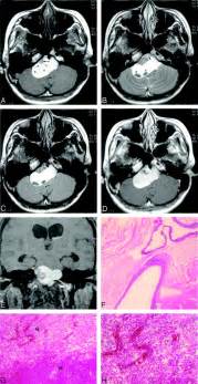 Intracranial Epidermoid Cyst With Hemorrhage Mr Imaging Findings