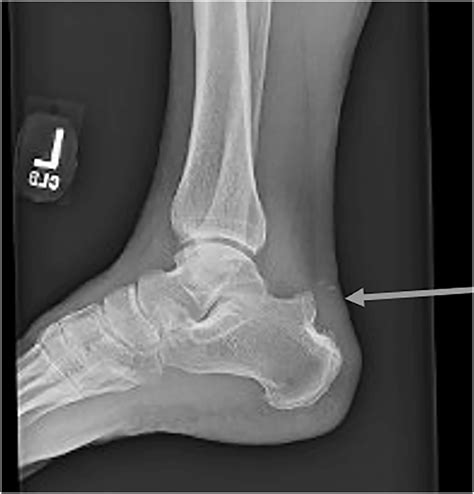 Haglund Deformity Of The Posterior Heel