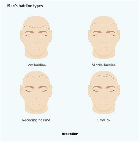 Understanding Hairlines