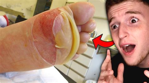 Guy Peels His Foot And It Is So Satisfying Youtube
