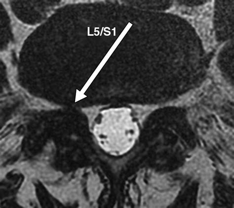 Quantitative Radiologic Criteria For The Diagnosis Of