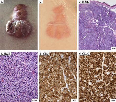 Fig E2 Primary Cutaneous Anaplastic Large Cell Lymphoma In Patients