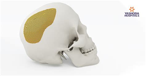 Doctors Prepare Artificial Skull Bone Using 3d Printing Technology