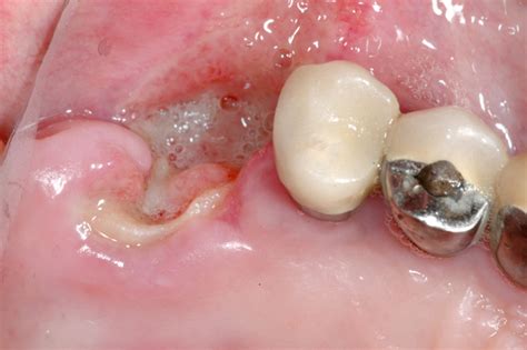 Jaw Osteonecrosis Picture From Ui Dentistry Hardin Md