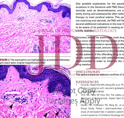 Mild Papillary Dermal Edema And A Perivascular And Interstital