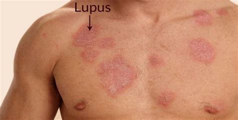 Remedios Caseros Y Recomendaciones Para Combatir El Lupus Naturalmente