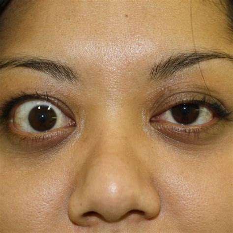 Before And After Thyroid Eye Disease