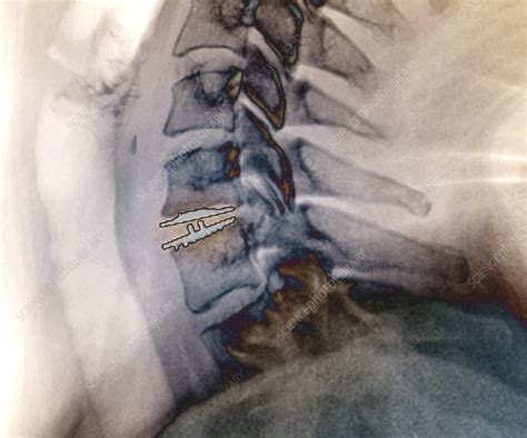 Cervical Intervertebral Disc Implant X Ray Stock Image C0403337