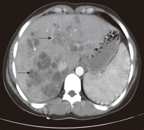Figure Radiological Imaging Features Of Fasciola Hepatica Infection