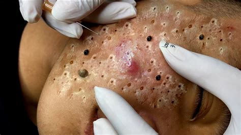 Remove Lots Of Blackheads And Whiteheads YouTube