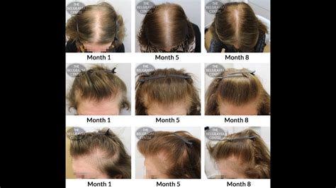 How To Grow Baby Hairs On Forehead Get More Anythinks