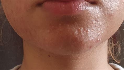 Skin Concern Ive Had These Bumps On My Chin For About 23 Years Now