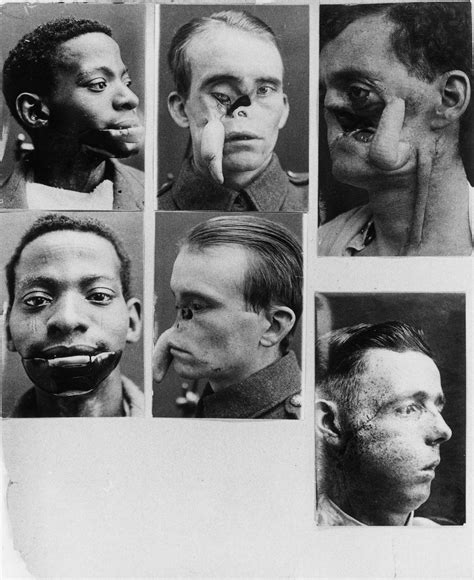 Soldiers With Broken Faces Graphic Photos Behind The Origins Of