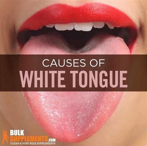 Tablo Read White Tongue Symptoms Causes And Treatment By