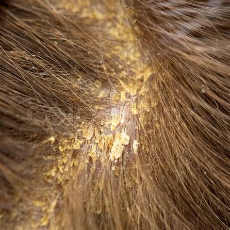 5 ml cedar oil, to 16oz water, and 8 drops lemon grass essential oil. Dandruff in the hair. Flaky scalp. ... | Stock image ...