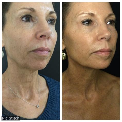 Before And After Photo Hilton Head Plastic Surgery And Medspa