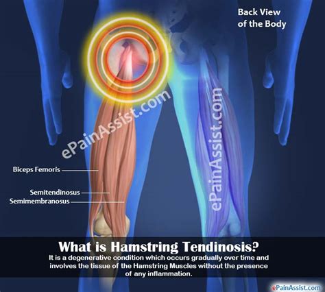 Hamstring Tendinosis