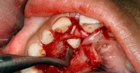A mesiodens is the most common supernumary (extra) tooth. ORAL SURGERY : Inverted mesiodens: case report - odontobebe