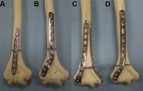 Plate Selection For Fixation Of Extra Articular Distal Humerus
