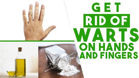 How To Get Rid Of Warts On Hands And Fingers Youtube