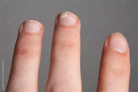 Leukonychia White Spots On The Nails Calcium And Vitamin Deficiency