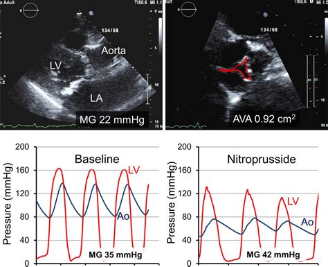 The Spectrum Of Low Output Low Gradient Aortic Stenosis With Normal