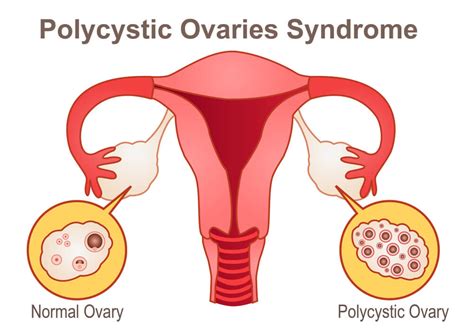 Vivre Avec Le Syndrome Des Ovaires Polykystiques Quoi Cela Ressemble