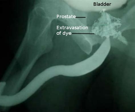 Figure Retrograde Urethrogram Image Courtesy S Bhimji Md