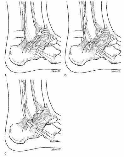 Lateral Ankle Ligament Reconstruction With And Without Split Peroneus