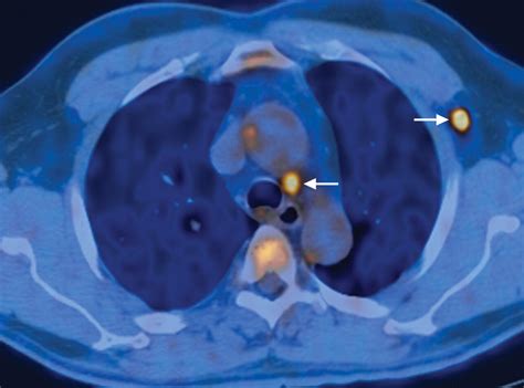 Petct Of Esophageal Cancer Its Role In Clinical Management