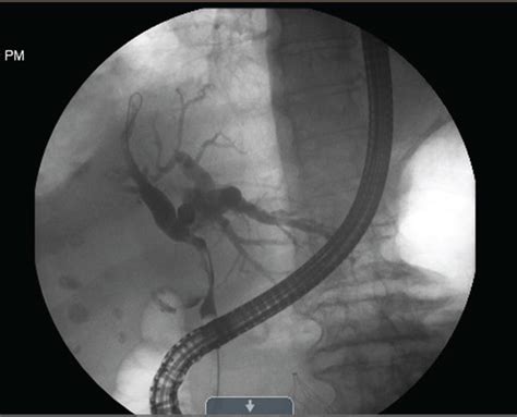 Preoperative Ercp Demonstrating A Significantly Dilated Intrahepatic