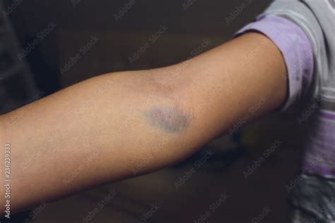 Bruises From Blood Collection Isolated Purple Bruise On The Arm Stock