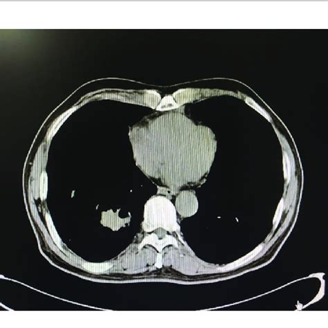 Chest Ct One Month After Surgery Download Scientific Diagram