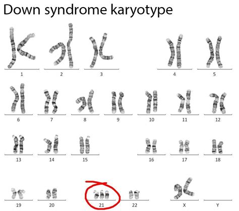 Down Syndrome Trisomy Stepwards