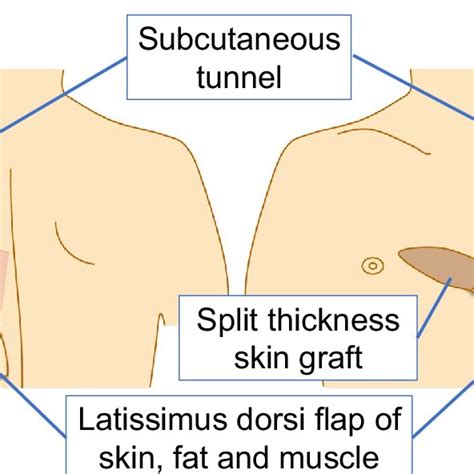 Schematic Of Thoracic Reconstruction With A Pedicled Latissimus Dorsi