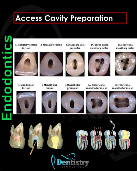 Access Cavity Preparation For All Teeth Dentistrty Dental Education Oral Health Endodontics