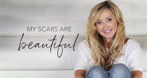 My Scars Are Beautiful How One Woman Learned To Lover Her Scars Scarred Beautiful