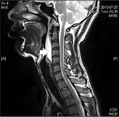 Sagittal T2 Weighted Mr Image Shows The High Signal Retropharyngeal