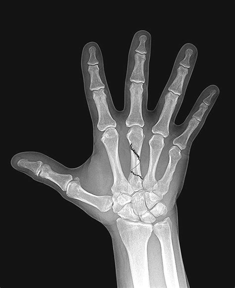 Spiral Fracture Finger X Ray Hand And Metacarpal Frac