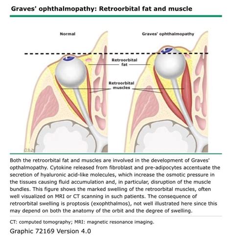 What Is The Difference Between Graves Disease And Hashimotos Disease