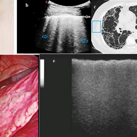 A Case Of Usual Interstitial Pneumonia Uip Fibrosis Histological